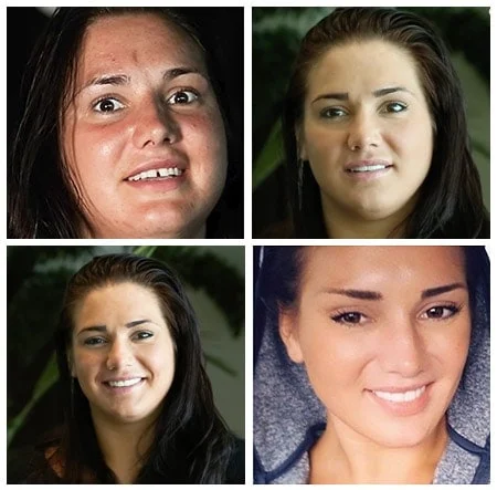 Kelsey Transformation Ibogaine Treatment Kelsey Transformation Ibogaine Treatment