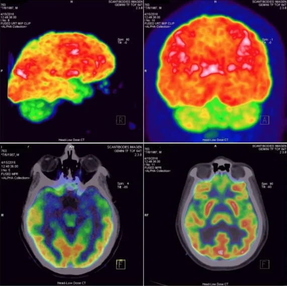 Healing the Brain after PTSD, Depression, And Medications